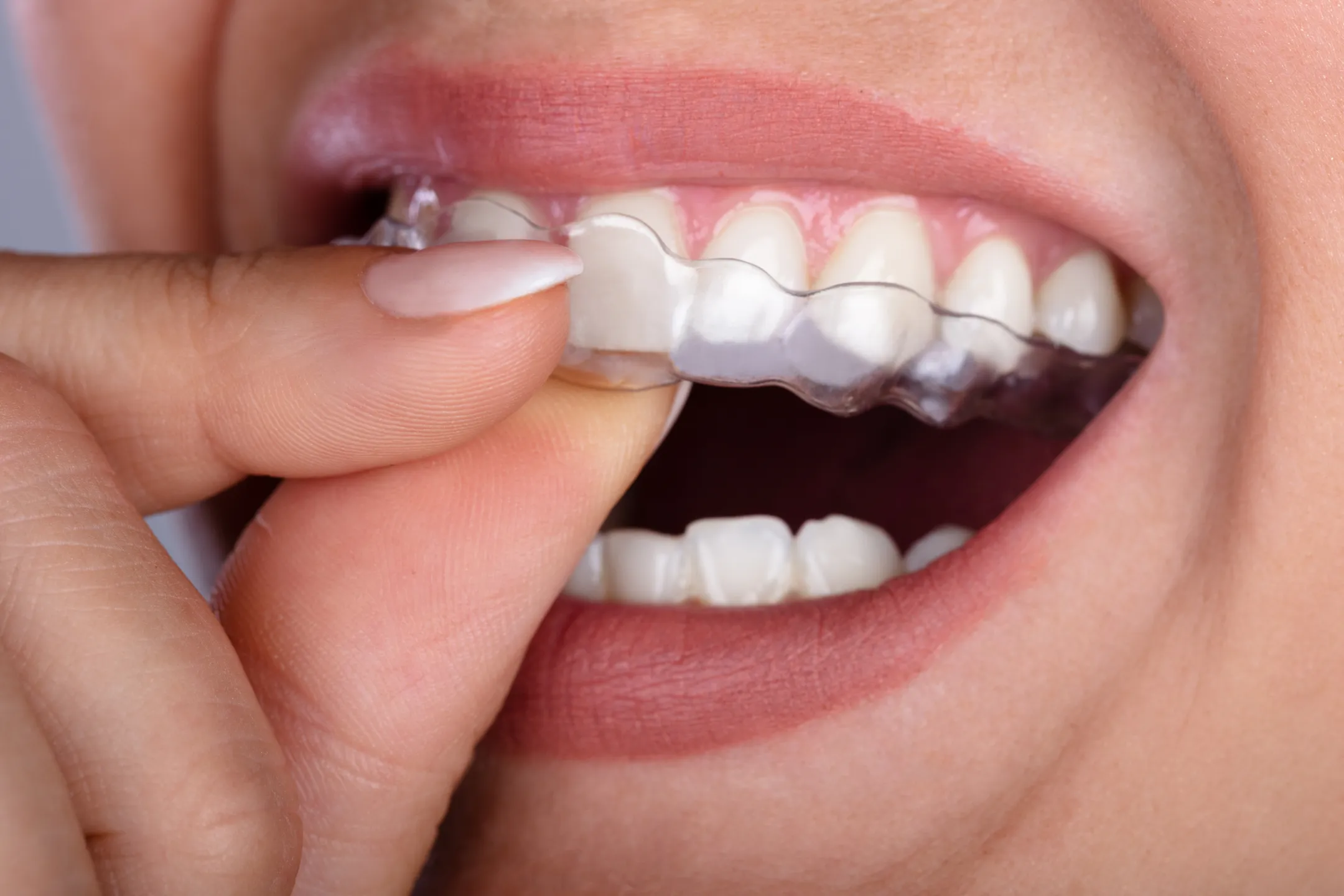 Close-up of a person inserting a clear dental aligner over their upper teeth.