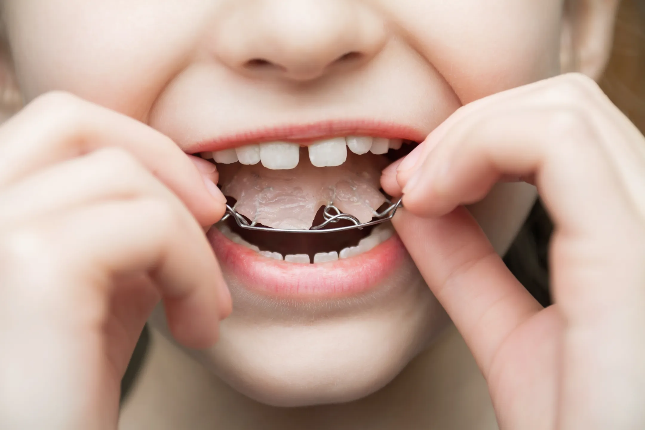 Child's mouth with loose front teeth wearing a clear dental retainer held by hands.