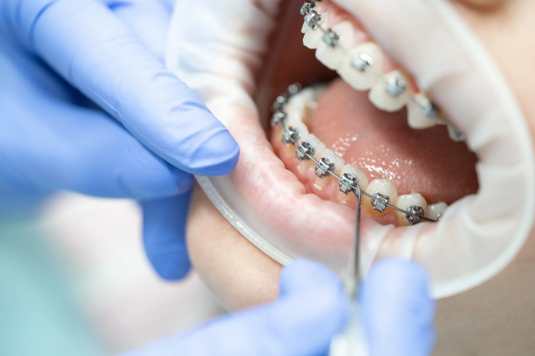 Braces